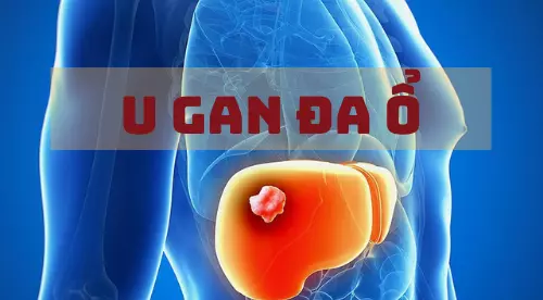 U gan đa ổ: Các dấu hiệu và cách điều trị bệnh hiệu quả